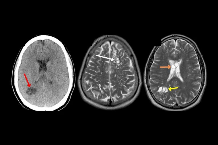 A Picture of neurocysticercosis