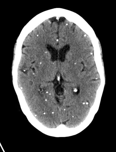 A picture of neurocysticercosis