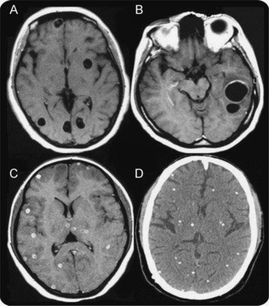 A picture of neurocysticercosis