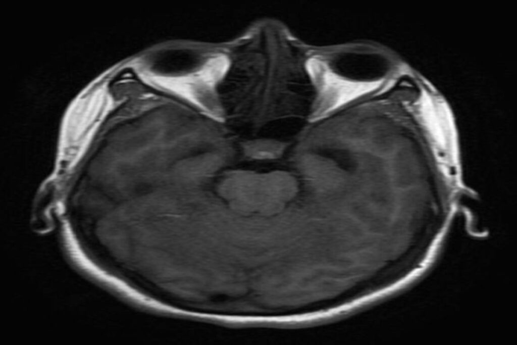 A picture of a neurocysticercosis